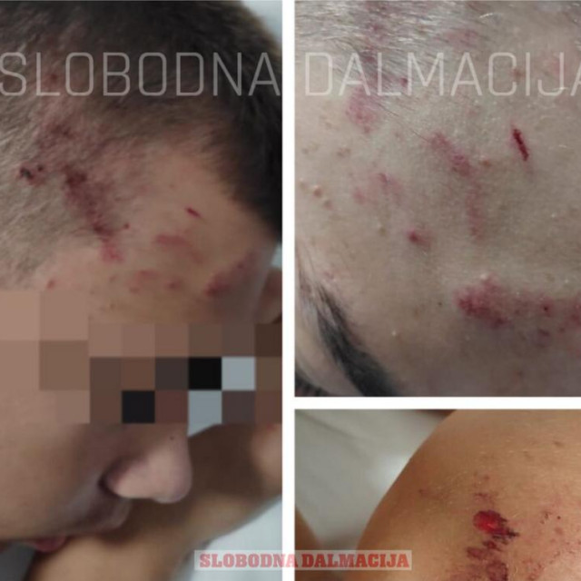 Dječaka su roditelji snimili u bolnici. Fotografije 14-godišnjaka objavljujemo uz dopuštenje roditelja koji navode da ne žele da se ovo ikad više dogodi nekom djetetu, a da se višestruki nasilnik opet izvuče! Kažu i da bi svima trebao biti javni interes da se ovakve stvari više nikad ne ponove