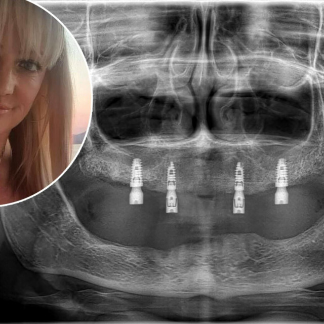 Britanka Leanne Abeyance (41) dijeli svoju priču kao upozorenje drugima