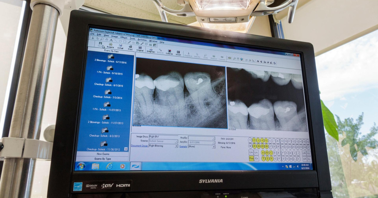 Korištenje ‘crnih plombi‘ odlazi u povijest