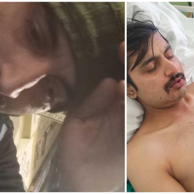 Vikrama su u bolnicu primili tek nakon što je zubar posumnjao na lom vilice