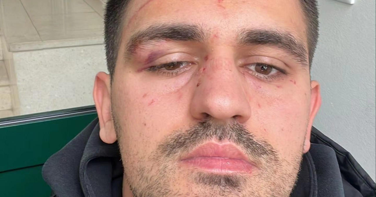 FOTO Igrači Metkovića tvrde da su napadnuti nakon utakmice, predsjednik domaćeg kluba ugrizao igrača za oko?!