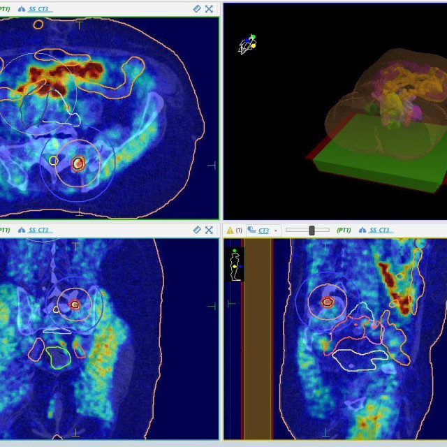 Stereotaksijska radioterapija
