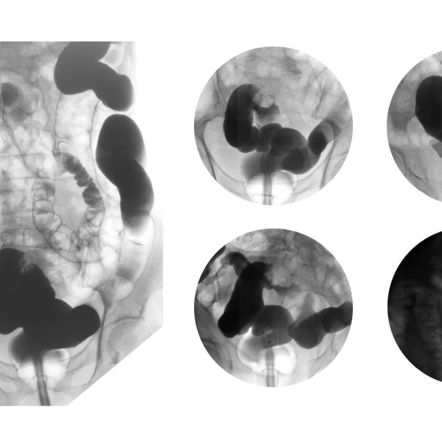 Dostupne terapije su ograničene, a rak se lako može previdjeti...