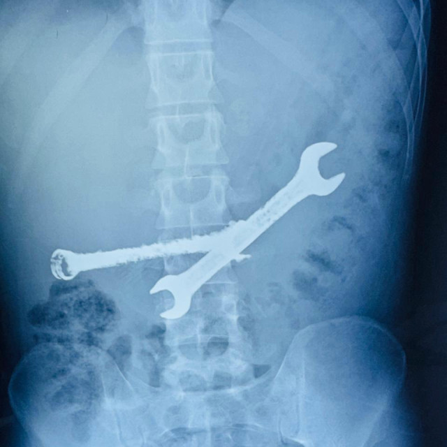 Strani predmeti u trbuhu nesretnog Indijca