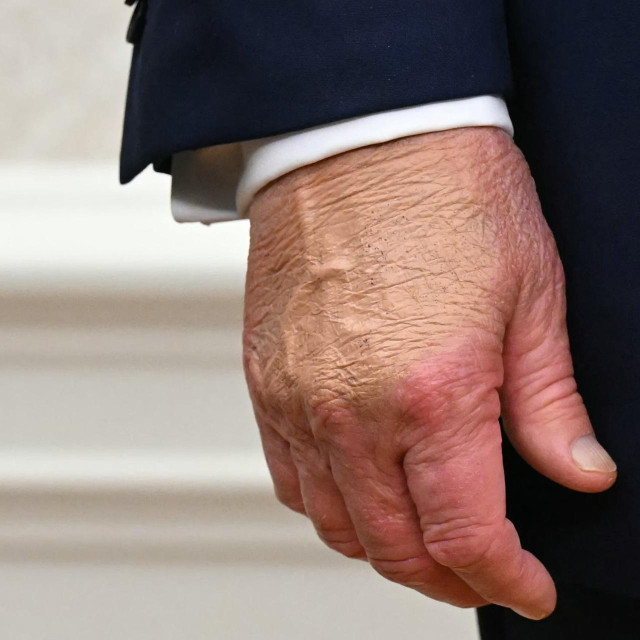 Zdravlje predsjednika SAD-a izaziva brojne polemike