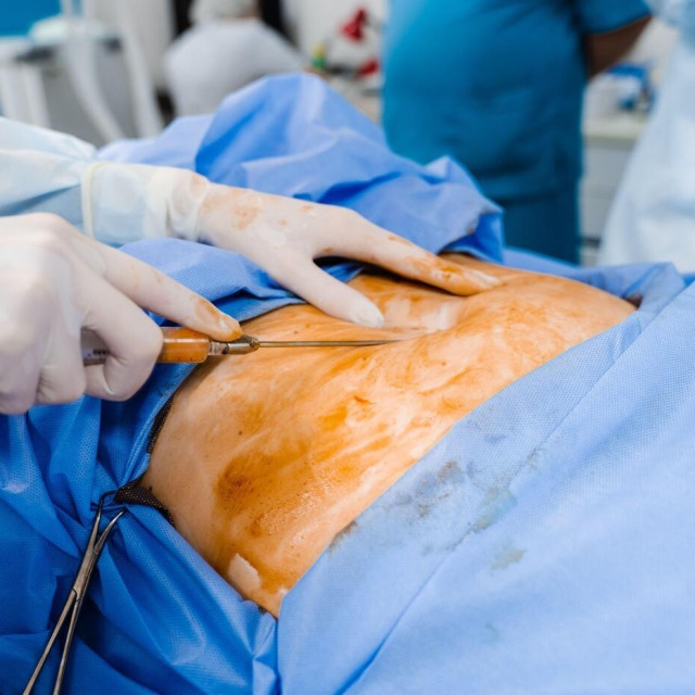 Liposukcija; ilustracija