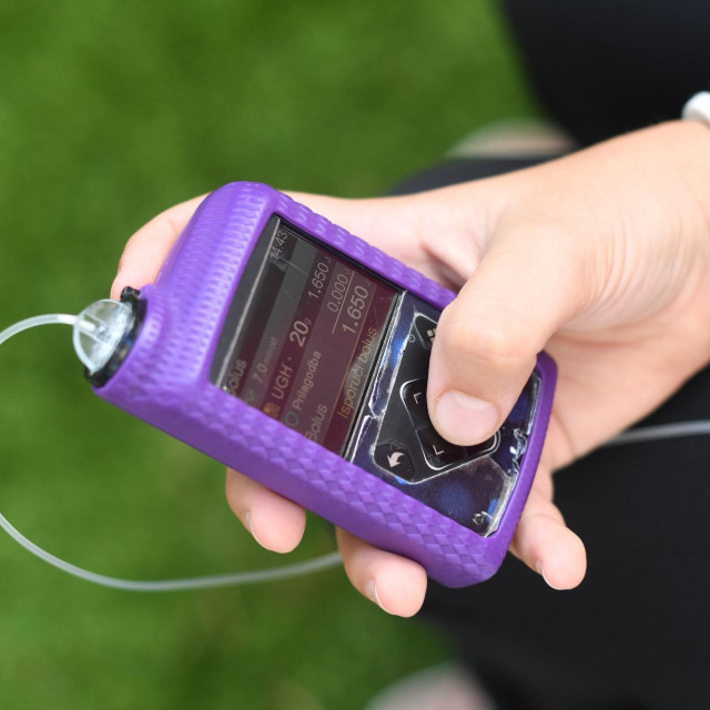 Dijabetička pumpa, ilustracija