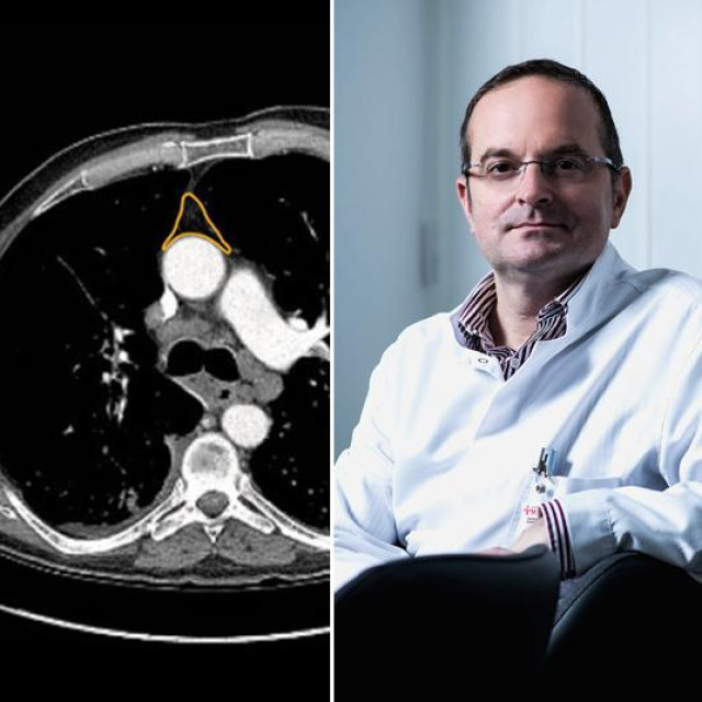 Timus na CT snimkama; dr. Dario Rahelić
