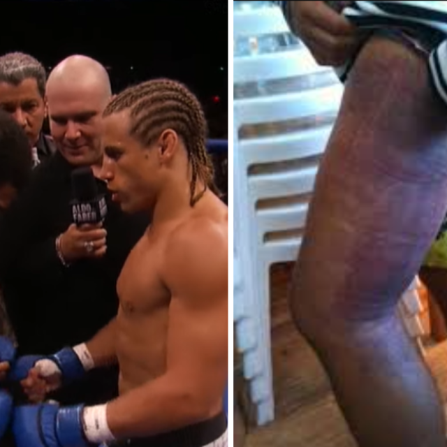 Jose Aldo vs. Urijah Faber | Faberova noga nakon meča