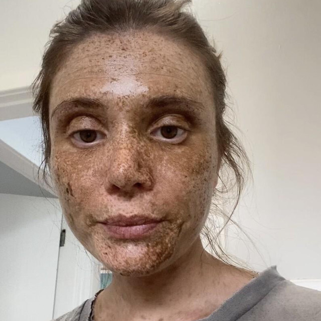 Olivia Hall nakon nezgode sa sprej tenom