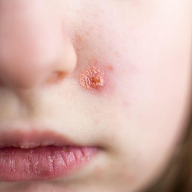 Impetigo; ilustracija